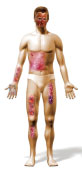 burn_body